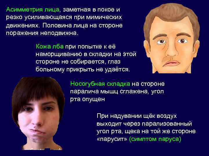 Неполный паралич половины тела