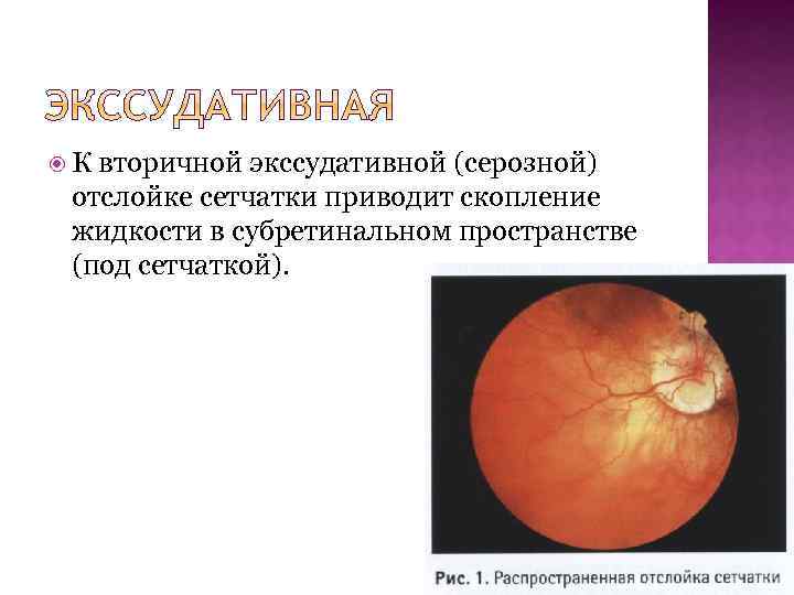  К вторичной экссудативной (серозной) отслойке сетчатки приводит скопление жидкости в субретинальном пространстве (под