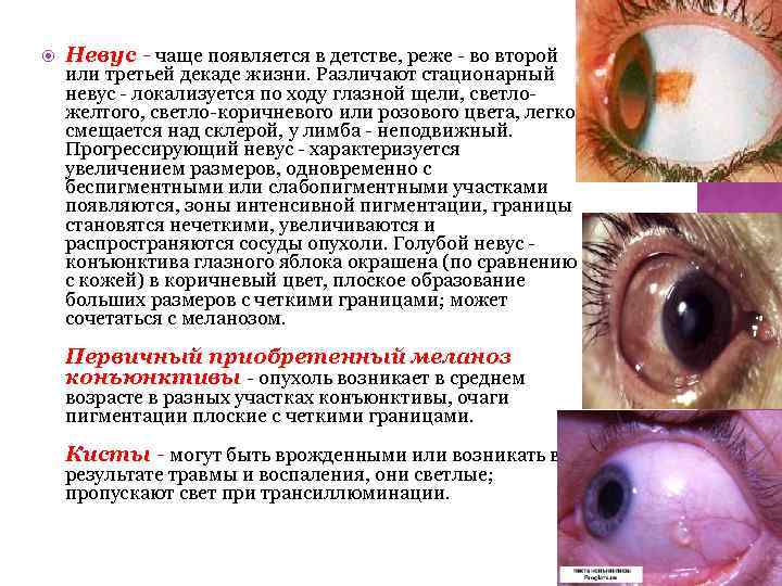  Невус - чаще появляется в детстве, реже - во второй или третьей декаде