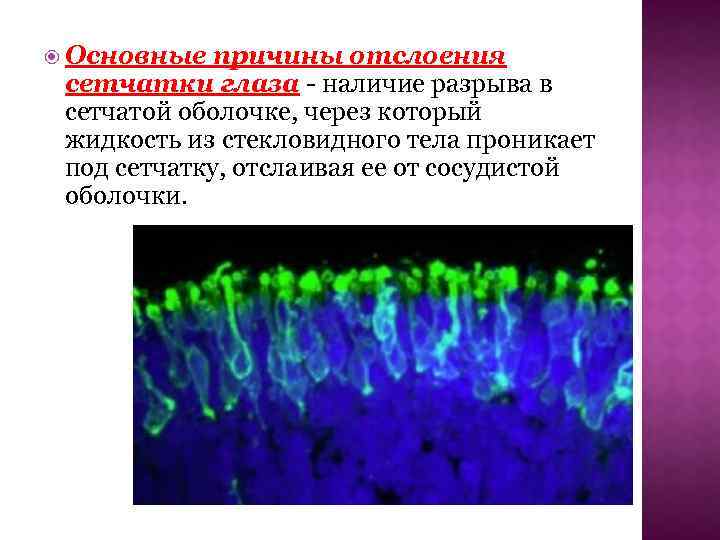  Основные причины отслоения сетчатки глаза - наличие разрыва в сетчатой оболочке, через который