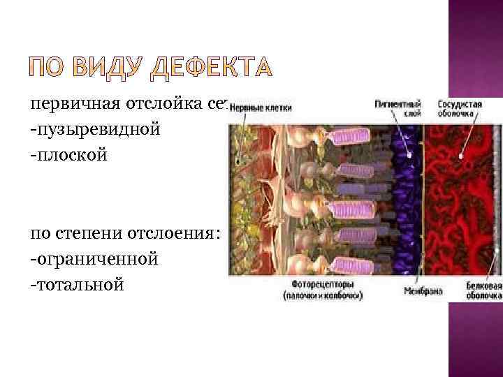 первичная отслойка сетчатки : -пузыревидной -плоской по степени отслоения: -ограниченной -тотальной 