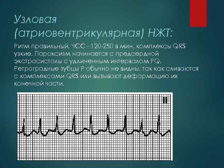 Узловой ритм сердца возникает когда роль водителя ритма берет на себя