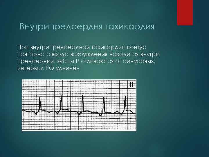 Внутрипредсердня тахикардия При внутрипредсердной тахикардии контур повторного входа возбуждения находится внутри предсердий, зубцы Р