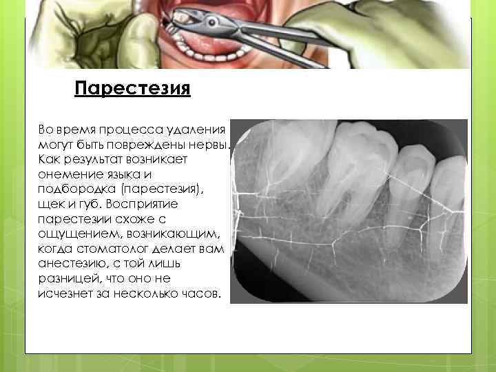 Парестезия Во время процесса удаления могут быть повреждены нервы. Как результат возникает онемение языка