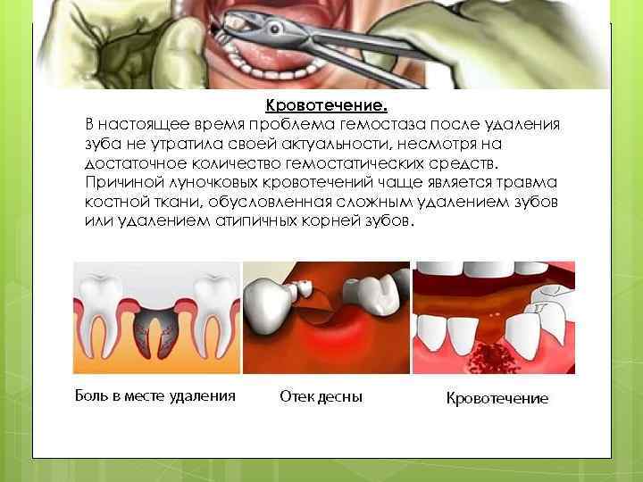 Кровотечение. В настоящее время проблема гемостаза после удаления зуба не утратила своей актуальности, несмотря