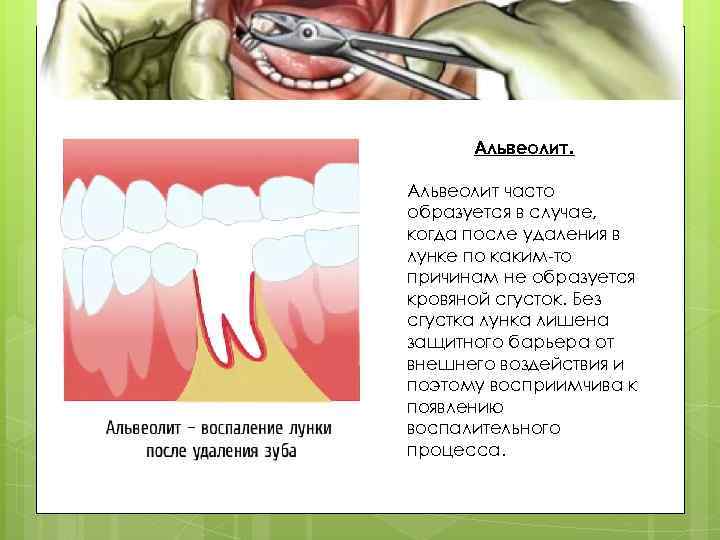 Альвеолит часто образуется в случае, когда после удаления в лунке по каким-то причинам не