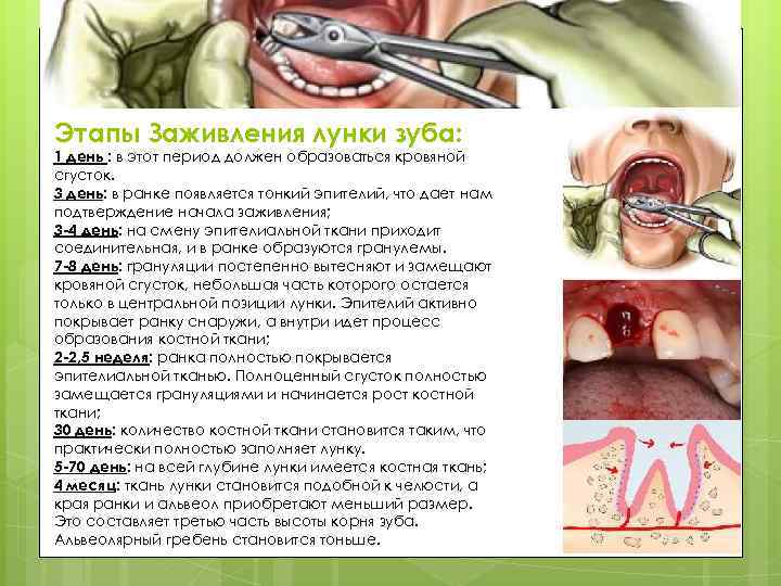 Этапы Заживления лунки зуба: 1 день : в этот период должен образоваться кровяной сгусток.