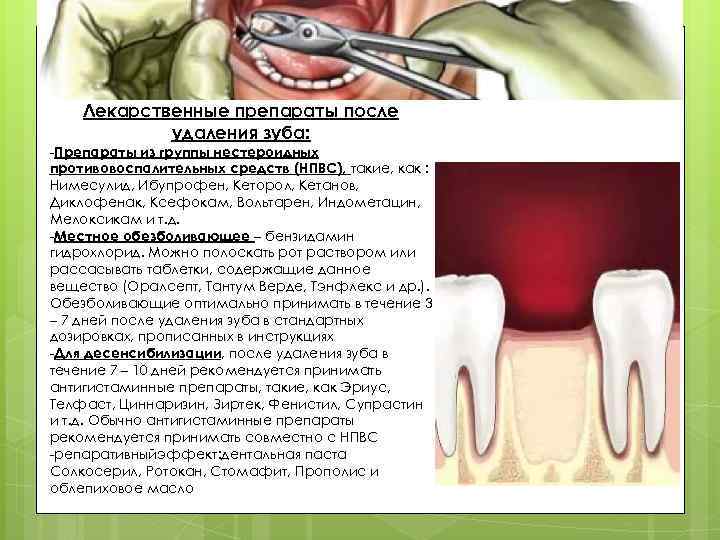 Лекарственные препараты после удаления зуба: -Препараты из группы нестероидных противовоспалительных средств (НПВС), такие, как