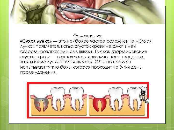 Осложнения: «Сухая лунка» — это наиболее частое осложнение. «Сухая лунка» появляется, когда сгусток крови