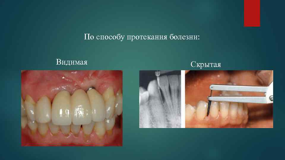 По способу протекания болезни: Видимая Скрытая 