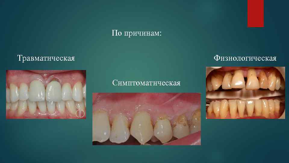 По причинам: Травматическая Физиологическая Симптоматическая 