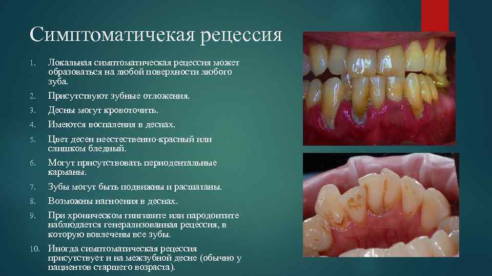 Симптоматичекая рецессия Локальная симптоматическая рецессия может образоваться на любой поверхности любого зуба. 2. Присутствуют