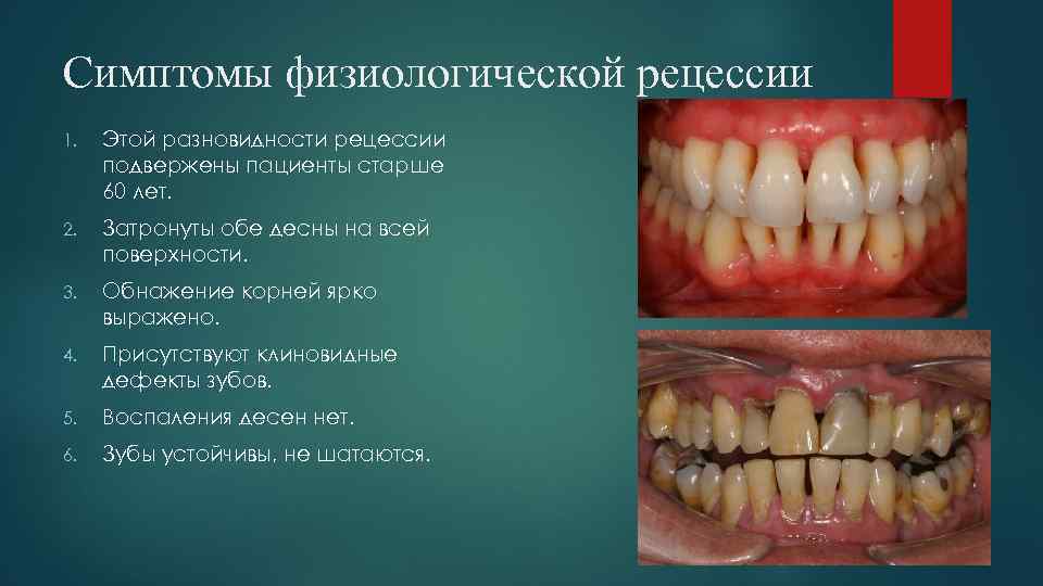 Симптомы физиологической рецессии 1. Этой разновидности рецессии подвержены пациенты старше 60 лет. 2. Затронуты