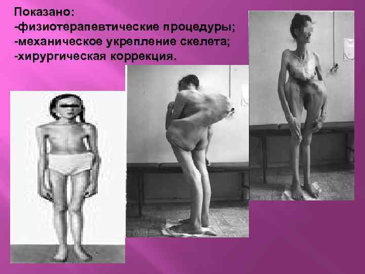 Показано: -физиотерапевтические процедуры; -механическое укрепление скелета; -хирургическая коррекция. 