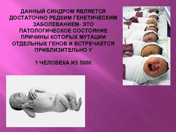 ДАННЫЙ СИНДРОМ ЯВЛЯЕТСЯ ДОСТАТОЧНО РЕДКИМ ГЕНЕТИЧЕСКИМ ЗАБОЛЕВАНИЕМ- ЭТО ПАТОЛОГИЧЕСКОЕ СОСТОЯНИЕ ПРИЧИНЫ КОТОРЫХ МУТАЦИИ ОТДЕЛЬНЫХ