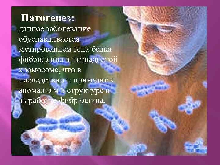 Патогенез: патогенезпппп данное заболевание обуславливается мутированием гена белка фибриллина в пятнадцатой хромосоме, что в