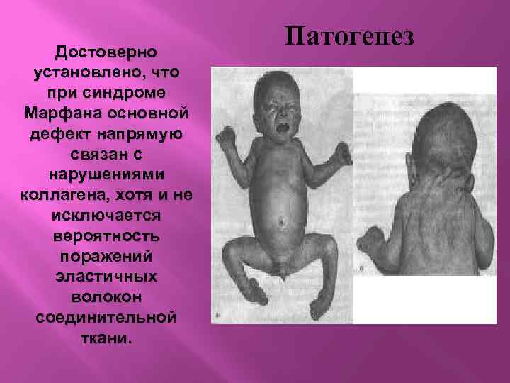 Достоверно установлено, что при синдроме Марфана основной дефект напрямую связан с нарушениями коллагена, хотя