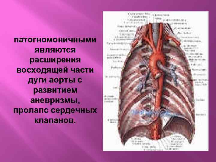 патогномоничными являются расширения восходящей части дуги аорты с развитием аневризмы, пролапс сердечных клапанов. 