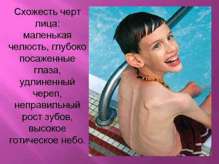 Схожесть черт лица: маленькая челюсть, глубоко посаженные глаза, удлиненный череп, неправильный рост зубов, высокое