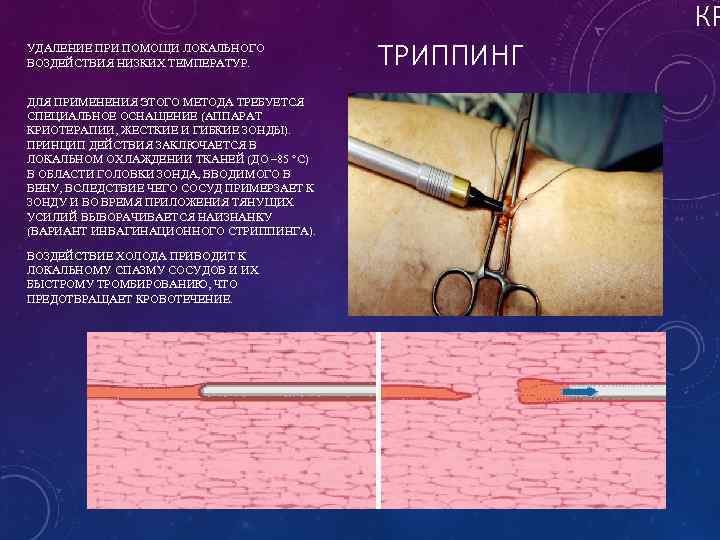 УДАЛЕНИЕ ПРИ ПОМОЩИ ЛОКАЛЬНОГО ВОЗДЕЙСТВИЯ НИЗКИХ ТЕМПЕРАТУР. ДЛЯ ПРИМЕНЕНИЯ ЭТОГО МЕТОДА ТРЕБУЕТСЯ СПЕЦИАЛЬНОЕ ОСНАЩЕНИЕ