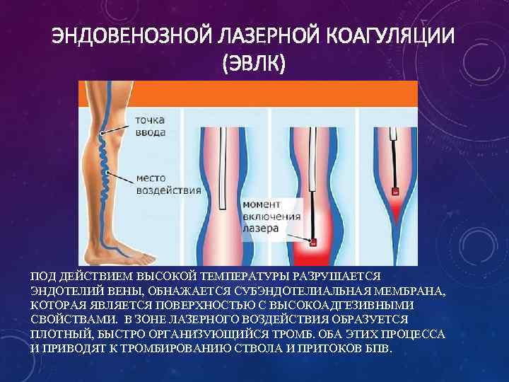 ЭНДОВЕНОЗНОЙ ЛАЗЕРНОЙ КОАГУЛЯЦИИ (ЭВЛК) ПОД ДЕЙСТВИЕМ ВЫСОКОЙ ТЕМПЕРАТУРЫ РАЗРУШАЕТСЯ ЭНДОТЕЛИЙ ВЕНЫ, ОБНАЖАЕТСЯ СУБЭНДОТЕЛИАЛЬНАЯ МЕМБРАНА,