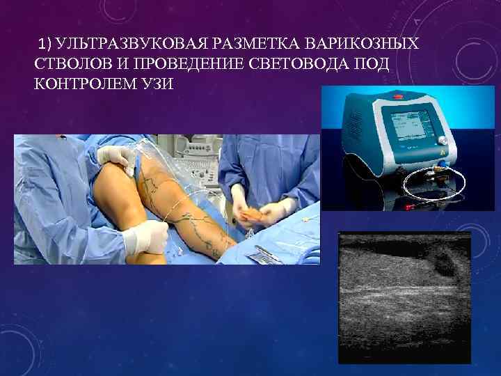  1) УЛЬТРАЗВУКОВАЯ РАЗМЕТКА ВАРИКОЗНЫХ СТВОЛОВ И ПРОВЕДЕНИЕ СВЕТОВОДА ПОД КОНТРОЛЕМ УЗИ 