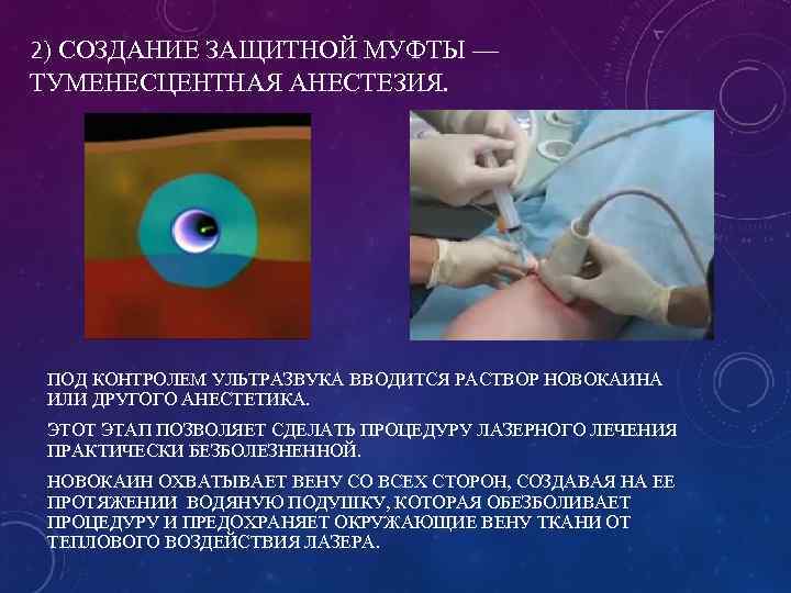 2) СОЗДАНИЕ ЗАЩИТНОЙ МУФТЫ — ТУМЕНЕСЦЕНТНАЯ АНЕСТЕЗИЯ. ПОД КОНТРОЛЕМ УЛЬТРАЗВУКА ВВОДИТСЯ РАСТВОР НОВОКАИНА ИЛИ