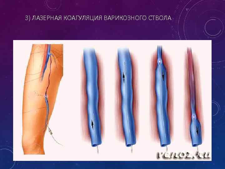 3) ЛАЗЕРНАЯ КОАГУЛЯЦИЯ ВАРИКОЗНОГО СТВОЛА 