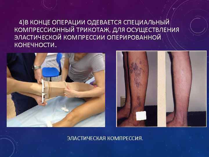  4)В КОНЦЕ ОПЕРАЦИИ ОДЕВАЕТСЯ СПЕЦИАЛЬНЫЙ КОМПРЕССИОННЫЙ ТРИКОТАЖ, ДЛЯ ОСУЩЕСТВЛЕНИЯ ЭЛАСТИЧЕСКОЙ КОМПРЕССИИ ОПЕРИРОВАННОЙ КОНЕЧНОСТИ.