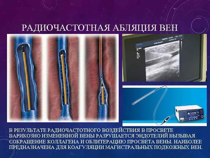 РАДИОЧАСТОТНАЯ АБЛЯЦИЯ ВЕН В РЕЗУЛЬТАТЕ РАДИОЧАСТОТНОГО ВОЗДЕЙСТВИЯ В ПРОСВЕТЕ ВАРИКОЗНО ИЗМЕНЕННОЙ ВЕНЫ РАЗРУШАЕТСЯ ЭНДОТЕЛИЙ