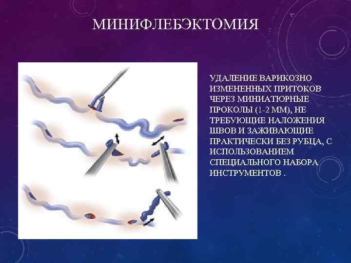 МИНИФЛЕБЭКТОМИЯ УДАЛЕНИЕ ВАРИКОЗНО ИЗМЕНЕННЫХ ПРИТОКОВ ЧЕРЕЗ МИНИАТЮРНЫЕ ПРОКОЛЫ (1 -2 ММ), НЕ ТРЕБУЮЩИЕ НАЛОЖЕНИЯ