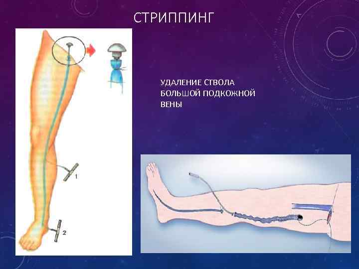 СТРИППИНГ УДАЛЕНИЕ СТВОЛА БОЛЬШОЙ ПОДКОЖНОЙ ВЕНЫ 