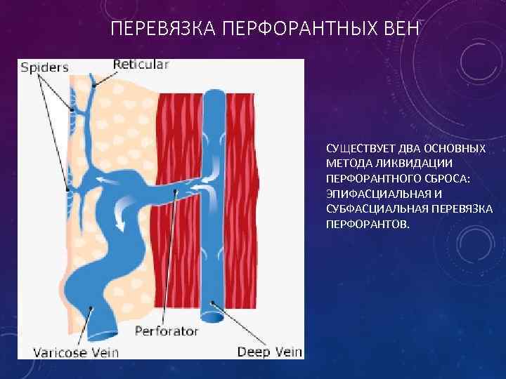 ПЕРЕВЯЗКА ПЕРФОРАНТНЫХ ВЕН СУЩЕСТВУЕТ ДВА ОСНОВНЫХ МЕТОДА ЛИКВИДАЦИИ ПЕРФОРАНТНОГО СБРОСА: ЭПИФАСЦИАЛЬНАЯ И СУБФАСЦИАЛЬНАЯ ПЕРЕВЯЗКА