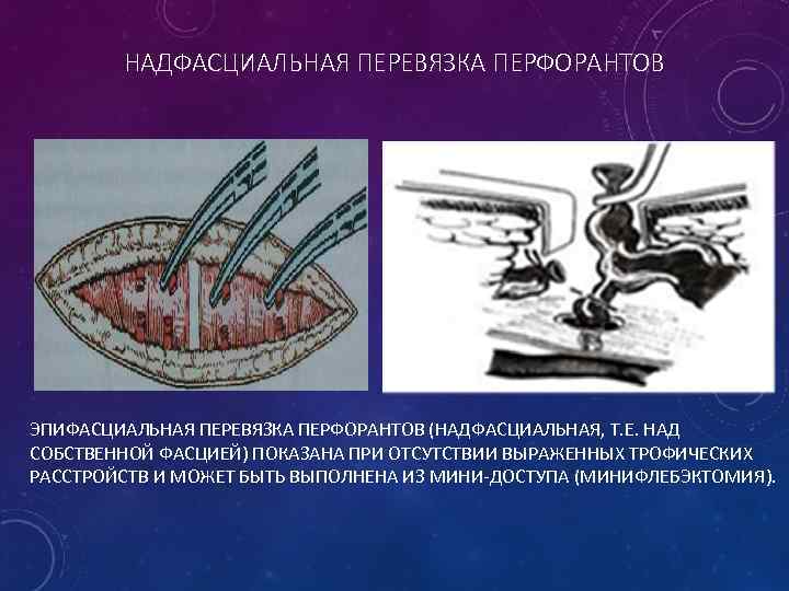 НАДФАСЦИАЛЬНАЯ ПЕРЕВЯЗКА ПЕРФОРАНТОВ ЭПИФАСЦИАЛЬНАЯ ПЕРЕВЯЗКА ПЕРФОРАНТОВ (НАДФАСЦИАЛЬНАЯ, Т. Е. НАД СОБСТВЕННОЙ ФАСЦИЕЙ) ПОКАЗАНА ПРИ