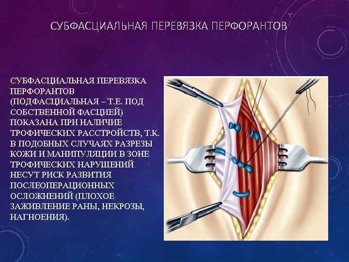 СУБФАСЦИАЛЬНАЯ ПЕРЕВЯЗКА ПЕРФОРАНТОВ (ПОДФАСЦИАЛЬНАЯ – Т. Е. ПОД СОБСТВЕННОЙ ФАСЦИЕЙ) ПОКАЗАНА ПРИ НАЛИЧИЕ ТРОФИЧЕСКИХ