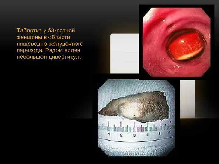 Таблетка у 53 -летней женщины в области пищеводно-желудочного перехода. Рядом виден небольшой дивертикул. 