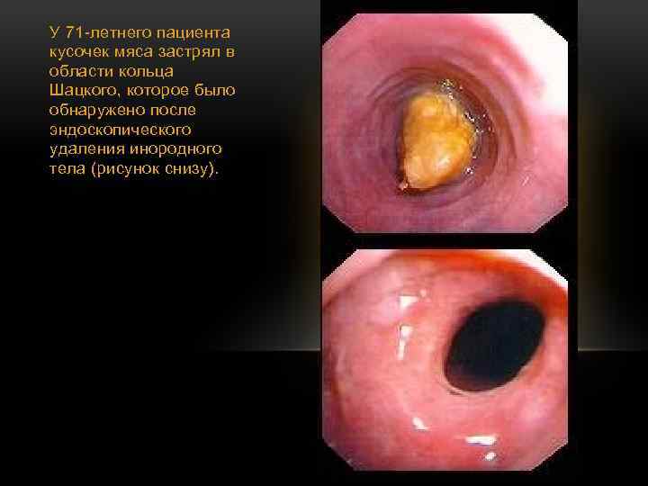 У 71 -летнего пациента кусочек мяса застрял в области кольца Шацкого, которое было обнаружено