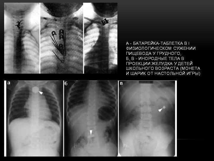А - БАТАРЕЙКА-ТАБЛЕТКА В I ФИЗИОЛОГИЧЕСКОМ СУЖЕНИИ ПИЩЕВОДА У ГРУДНОГО, Б, В - ИНОРОДНЫЕ