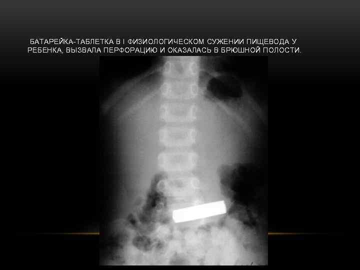  БАТАРЕЙКА-ТАБЛЕТКА В I ФИЗИОЛОГИЧЕСКОМ СУЖЕНИИ ПИЩЕВОДА У РЕБЕНКА, ВЫЗВАЛА ПЕРФОРАЦИЮ И ОКАЗАЛАСЬ В