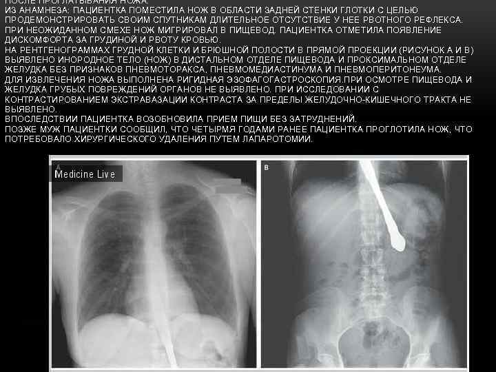 ПОСЛЕ ПРОГЛАТЫВАНИЯ НОЖА. ИЗ АНАМНЕЗА: ПАЦИЕНТКА ПОМЕСТИЛА НОЖ В ОБЛАСТИ ЗАДНЕЙ СТЕНКИ ГЛОТКИ С