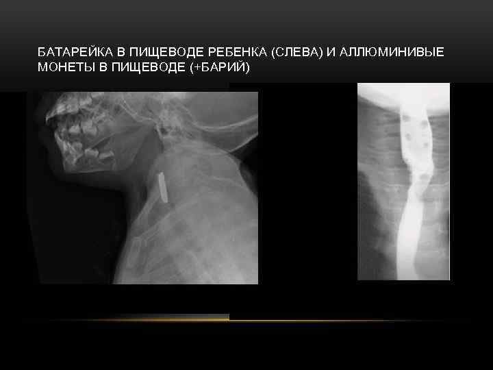 БАТАРЕЙКА В ПИЩЕВОДЕ РЕБЕНКА (СЛЕВА) И АЛЛЮМИНИВЫЕ МОНЕТЫ В ПИЩЕВОДЕ (+БАРИЙ) 