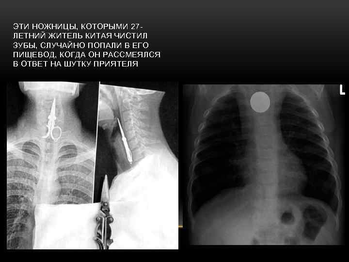 ЭТИ НОЖНИЦЫ, КОТОРЫМИ 27 ЛЕТНИЙ ЖИТЕЛЬ КИТАЯ ЧИСТИЛ ЗУБЫ, СЛУЧАЙНО ПОПАЛИ В ЕГО ПИЩЕВОД,