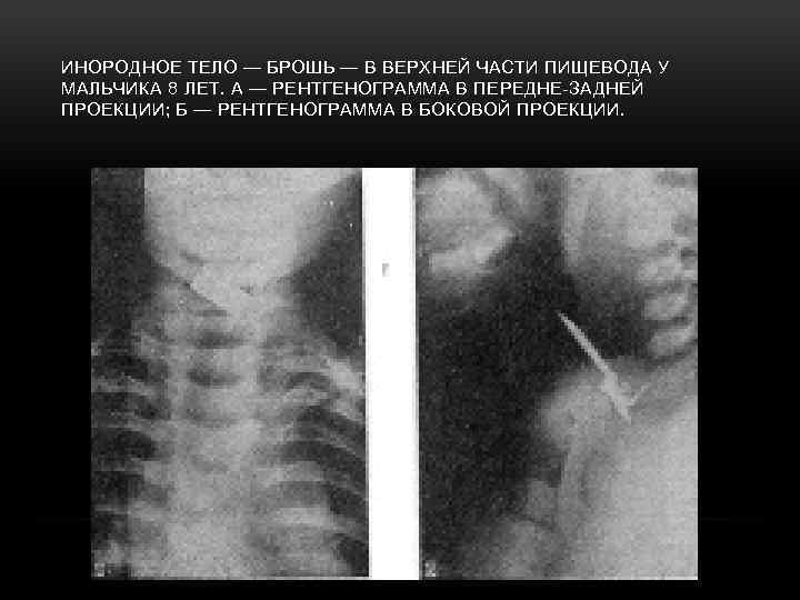 Инородное тело пищевода карта вызова скорой медицинской