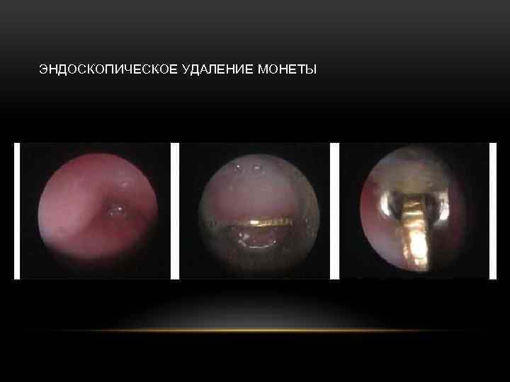 ЭНДОСКОПИЧЕСКОЕ УДАЛЕНИЕ МОНЕТЫ 