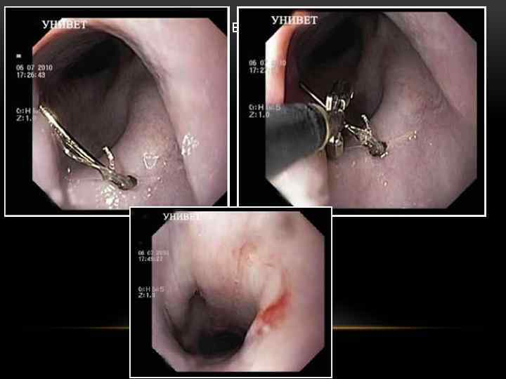 ЭНДОСКОПИЧЕСКОЕ УДАЛЕНИЕ 