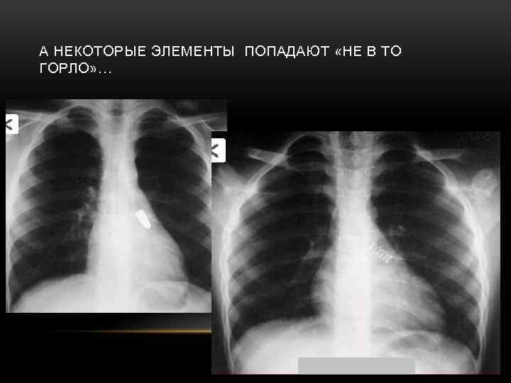 А НЕКОТОРЫЕ ЭЛЕМЕНТЫ ПОПАДАЮТ «НЕ В ТО ГОРЛО» … 