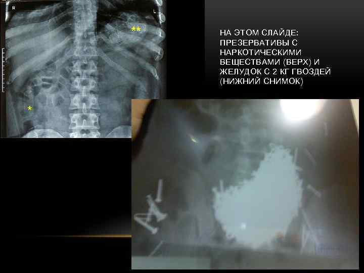 НА ЭТОМ СЛАЙДЕ: ПРЕЗЕРВАТИВЫ С НАРКОТИЧЕСКИМИ ВЕЩЕСТВАМИ (ВЕРХ) И ЖЕЛУДОК С 2 КГ ГВОЗДЕЙ