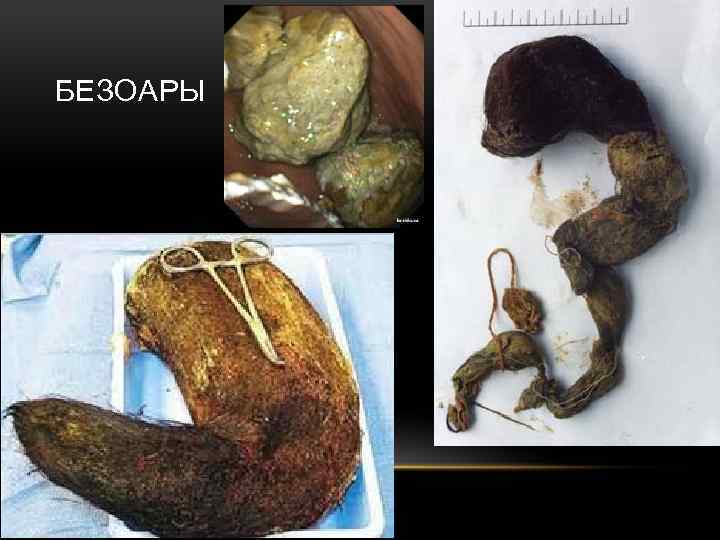 БЕЗОАРЫ 