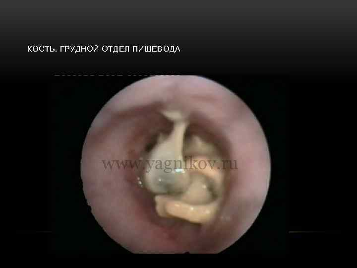 КОСТЬ. ГРУДНОЙ ОТДЕЛ ПИЩЕВОДА 