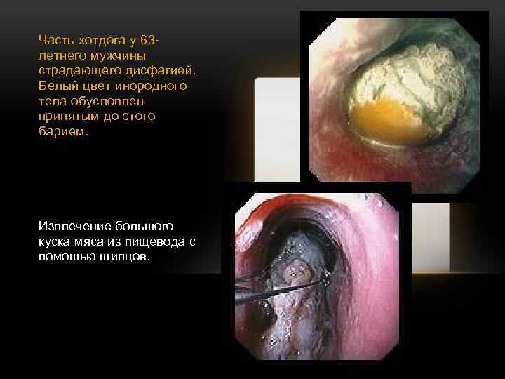 Часть хотдога у 63 летнего мужчины страдающего дисфагией. Белый цвет инородного тела обусловлен принятым